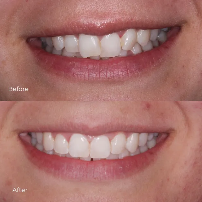 Invisalign (2)