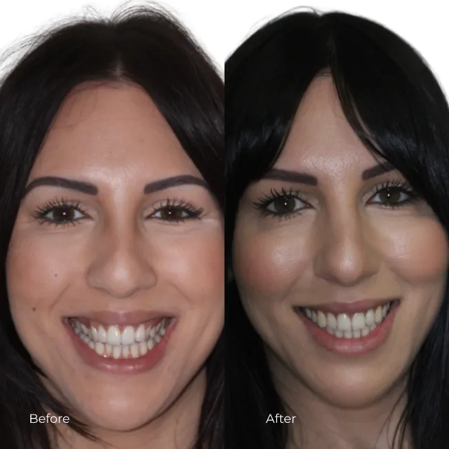 Invisalign (2)