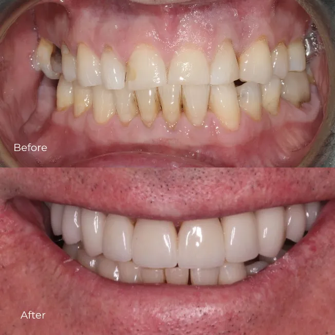Veneers (2)