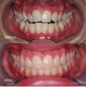 Best Invisalign dentist Best Dentist